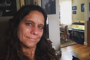 Mujer en Estados Unidos reveló el cambio tras extirparse más de 1000 tumores del rostro y cuello