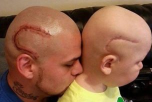 Murió el niño que tenía un tumor en su cabeza cuyo padre se hizo un tatuaje de su cicatriz