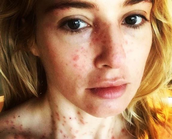 “No se asusten por mí”: Mane Swett da detalles de su salud tras publicar foto con psoriasis