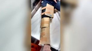 Entablillaron a paciente con cartón y cinta adhesiva en Hospital El Pino