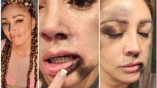 Carolina Molina envió respuesta a quienes aseguran que moretones tras brutal golpiza son maquillaje 