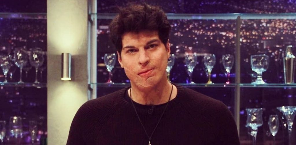 Ignacio Lastra y su anhelo por retomar el modelaje tras accidente: “Los estándares de belleza están cambiando”