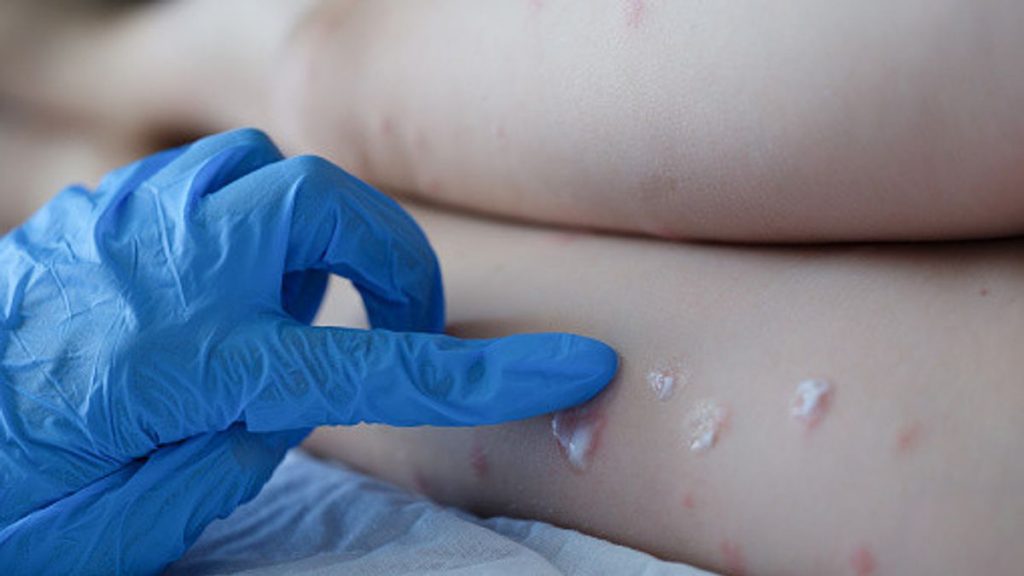 Dan a conocer reporte del estado de salud de chileno hospitalizado con viruela del mono en Italia