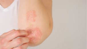 Novedosa terapia de células madre podría mejorar la calidad de vida de pacientes con psoriasis