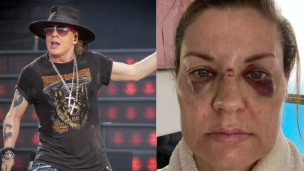 Fan quedó con graves lesiones tras ser golpeada por micrófono lanzado por Axl Rose en concierto de Guns N' Roses