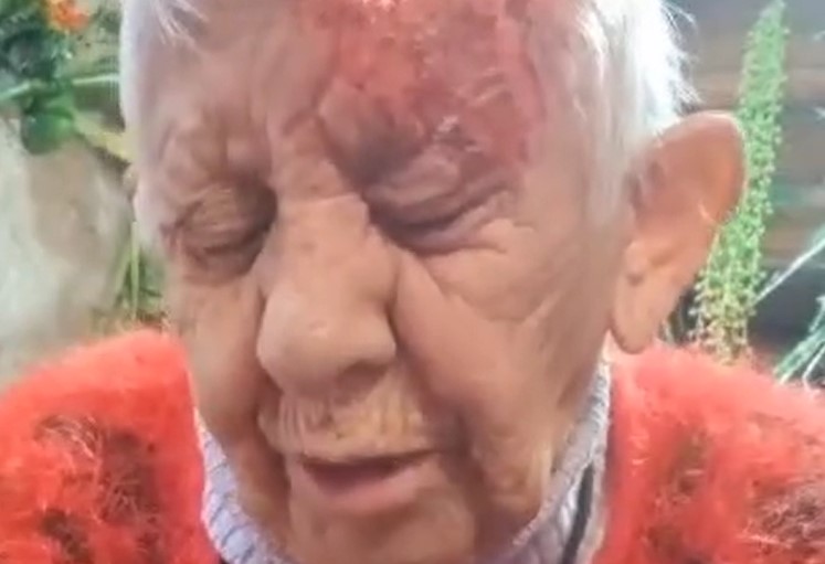 Denuncian que adulta mayor fue quemada con ácido en La Florida