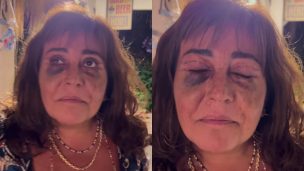 “Me operé…”: Helhue Sukni preocupó a sus seguidores tras mostrarse con hematomas en los ojos