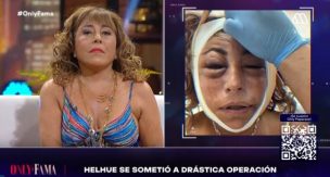 Helhue Sukni entrega detalles de drástica cirugía facial y revela motivo tras procedimiento