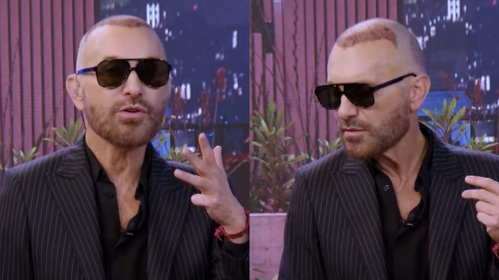 Jordi Castell reaparece en TV tras injerto capilar y revela detalles del postoperatorio