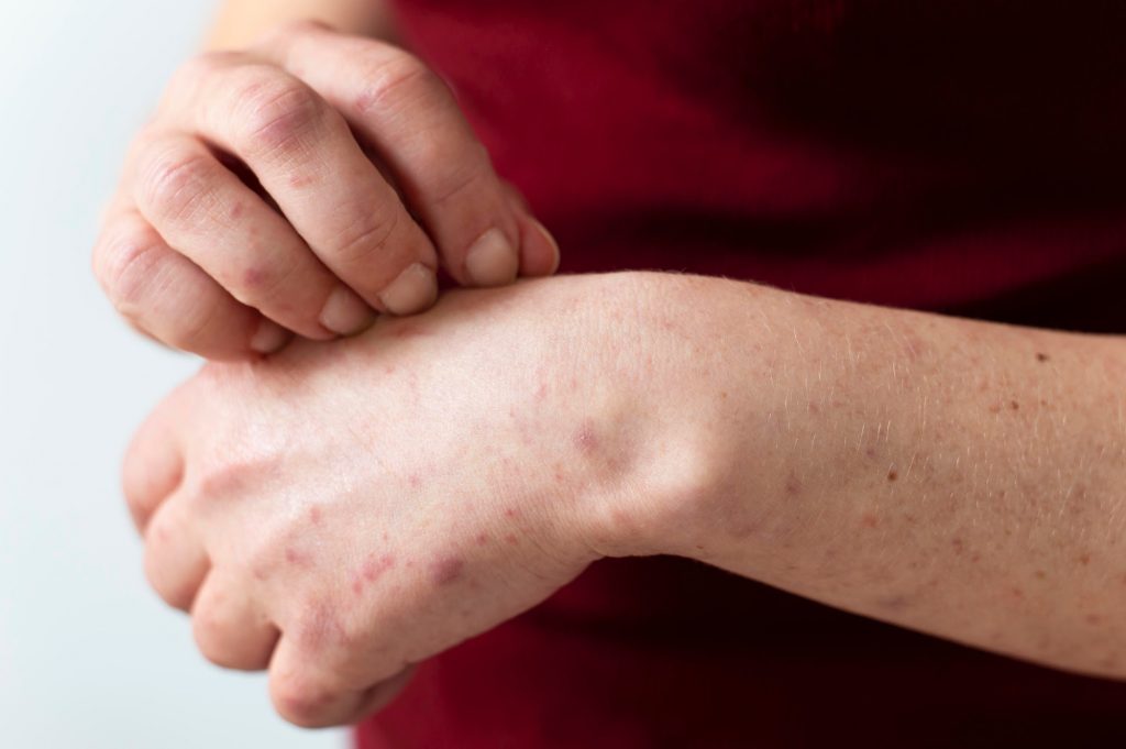 Alerta sanitaria por sarampión: una enfermedad de rápido contagio