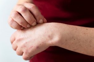 Alerta sanitaria por sarampión: una enfermedad de rápido contagio