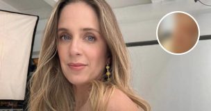 Alison Mandel muestra su pierna tras mordida de perro: