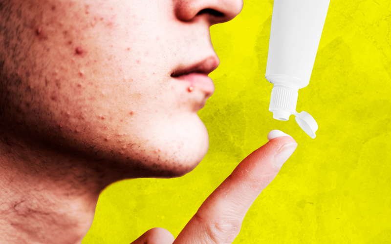 ¿Qué tan beneficioso es el uso de pasta dental para tratar las espinillas de la cara?