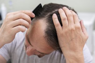 ISP alerta sobre riesgos de medicamento para la calvicie: Ideación suicida entre efectos adversos