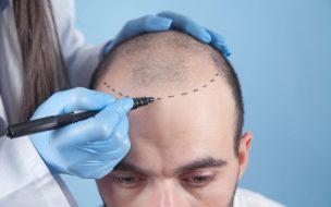 ¿Te estás quedando sin pelo?: En qué consisten los trasplantes que son furor en redes sociales