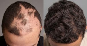 Más allá de la cicatriz: implante capilar gratuito transforma la vida de niños quemados