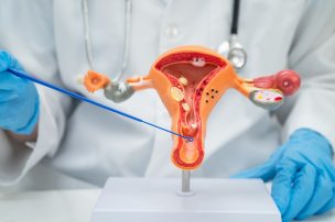 Papanicolau: ¿Por qué las mujeres no se realizan el examen clave para prevenir el cáncer?