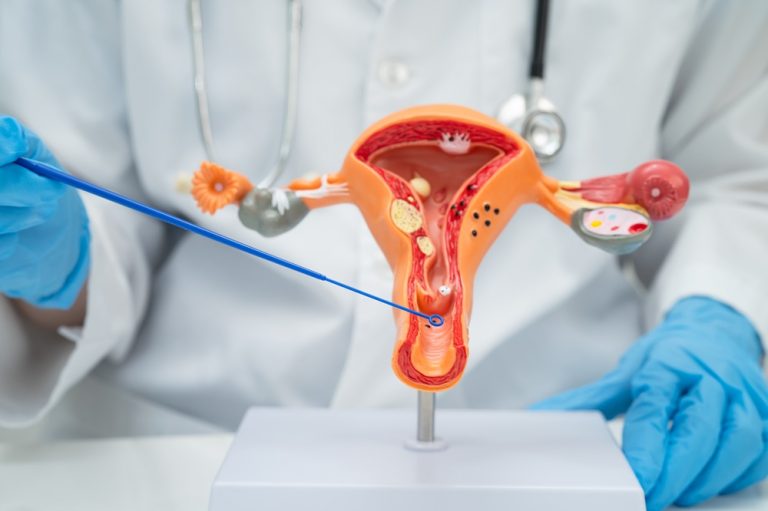 Papanicolau: ¿Por qué las mujeres no se realizan el examen clave para prevenir el cáncer?