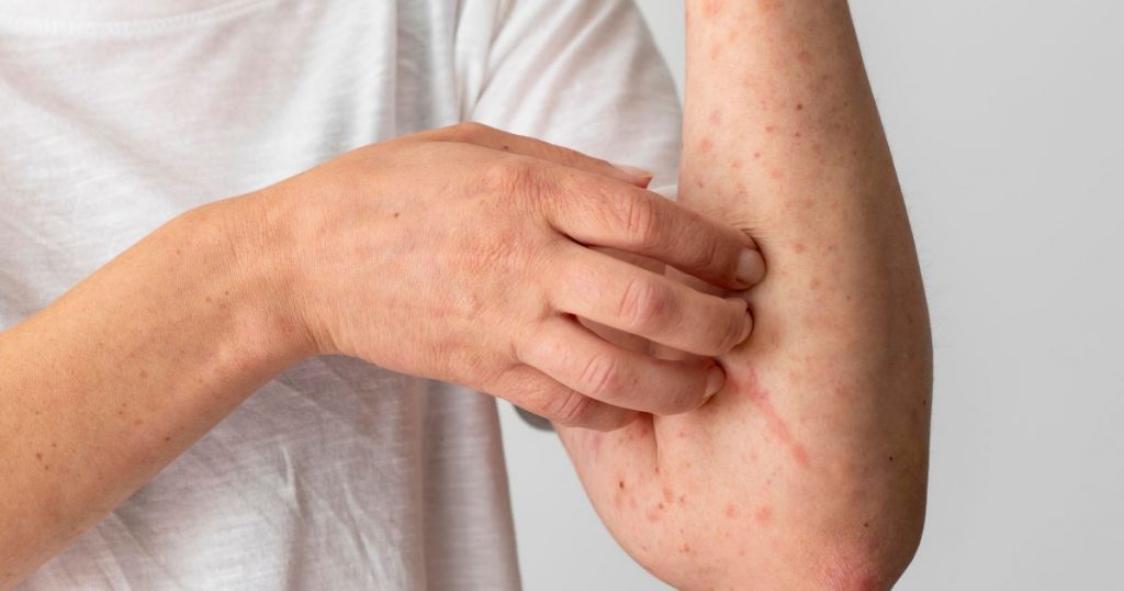 Experto advierte sobre el sarampión y entrega recomendaciones para prevenir contagios