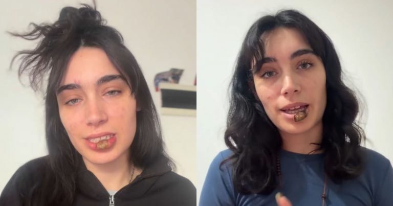 La joven que descubrió que tenía sífilis tras morderse el labio: su historia se volvió viral