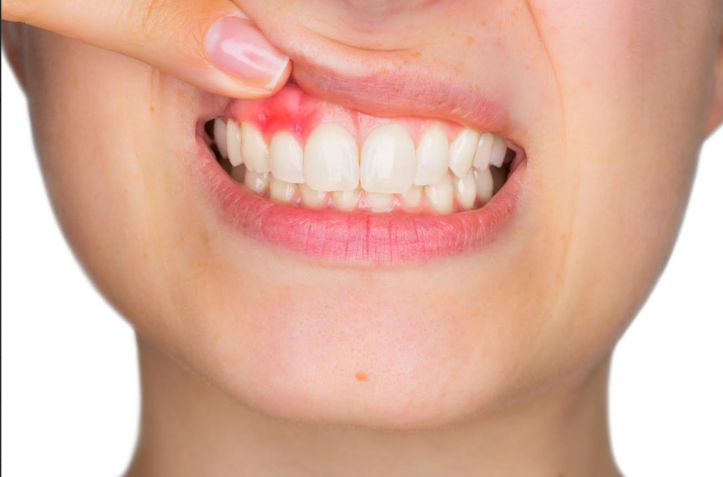 Conoce la enfermedad silenciosa que puede provocar la pérdida de dientes sanos