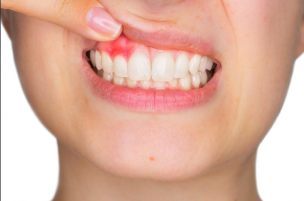 Conoce la enfermedad silenciosa que puede provocar la pérdida de dientes sanos
