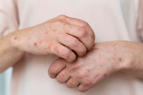Sífilis: qué es, cuáles son sus síntomas y las medidas clave para prevenir el contagio