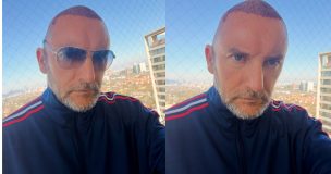 Daniel Fuenzalida sorprende con nuevo look tras someterse a un implante capilar: 