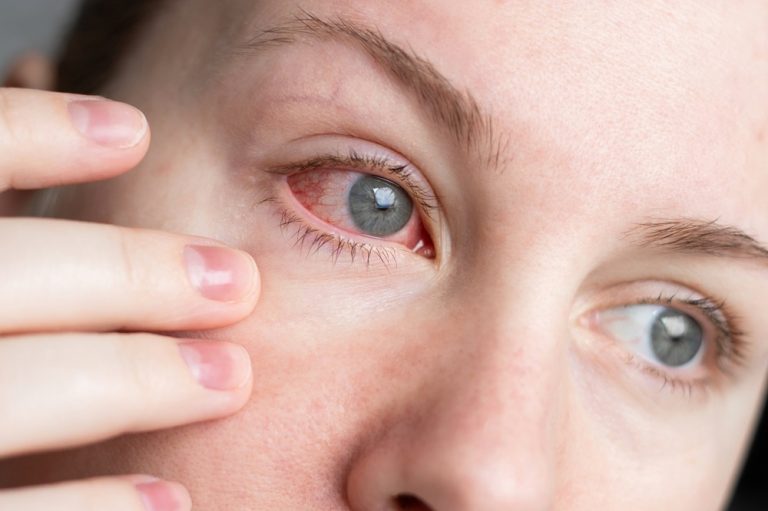 Ojos rojos, picazón y lagrimeo: las claves para saber si es alergia o infección